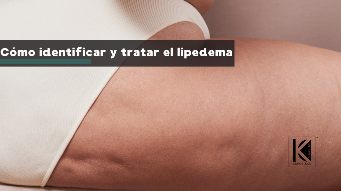 Lipedema en mujeres: la importancia de un diagnóstico temprano