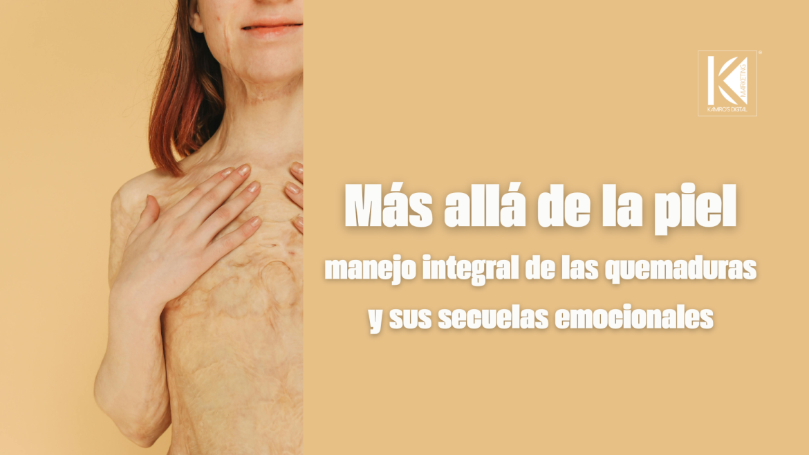 Quemaduras y salud mental: la importancia de un abordaje multidisciplinario